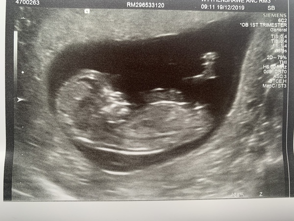 Sex guesses- 12 week scan