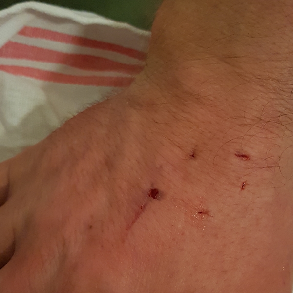 should DH go to OOH doctors with this? Or just treat at home? Savaged by local bully cat!