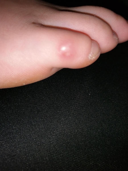 What's this on dd's toe?