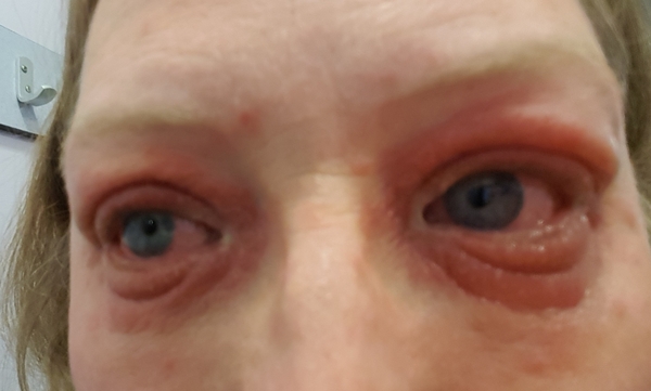 What is going on with my eyes?