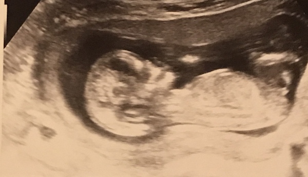 Sex guesses- 12 week scan