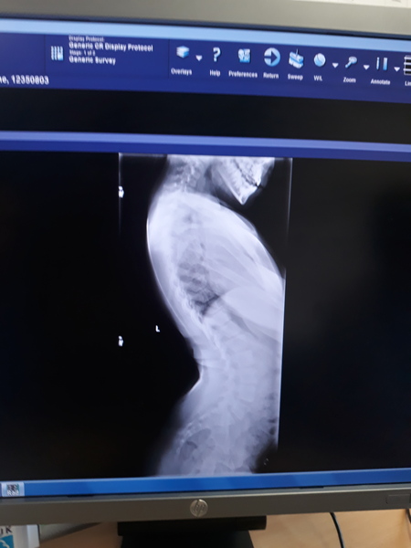 Self esteem and scoliosis