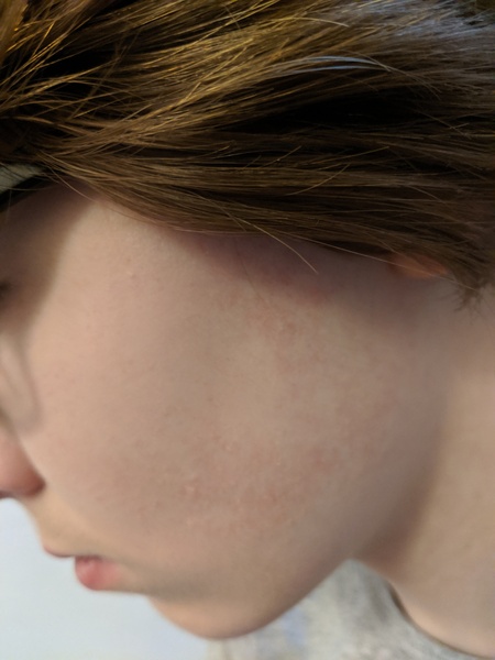 Diarrhea with slapped cheek? (Rash pic)