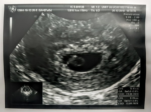 What should I expect to see on a scan at 7+5?