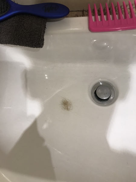 Hairloss -Some perspective please...