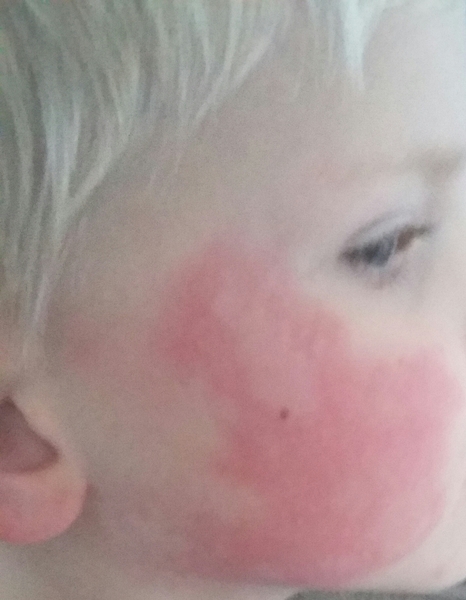 Help.  DH has broken out in this (pics)