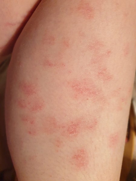 Any idea what this rash is?