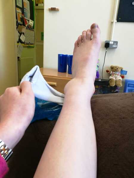 A&E treatment of Sprained ankle/suspected broken ankle