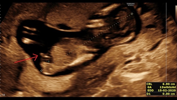 Boy or Girl from nub.. 12 week scan pic