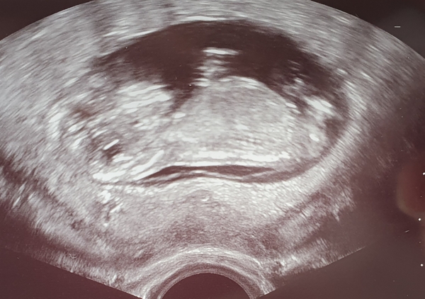 Sex guesses- 12 week scan