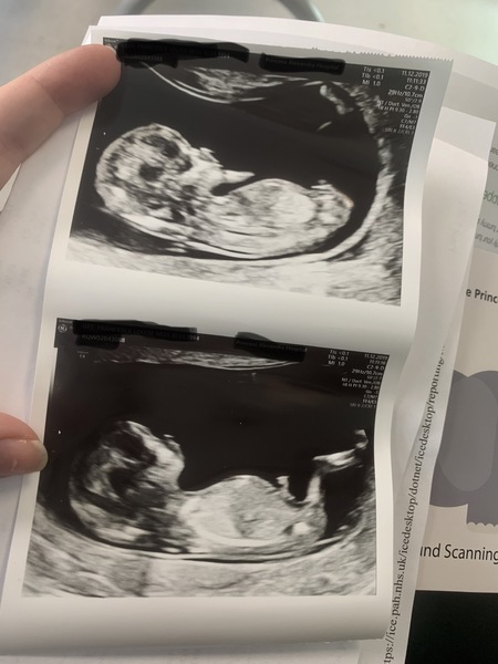 Just had a 12 week scan. Nub/skull theory guesses please? :)
