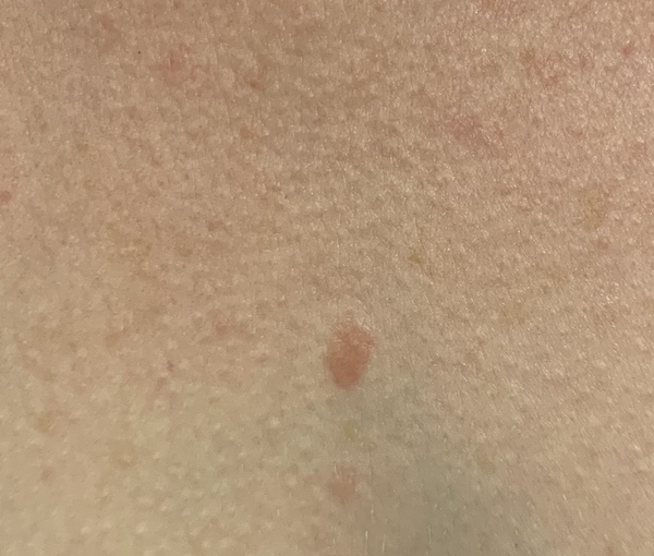 Spot appeared ...