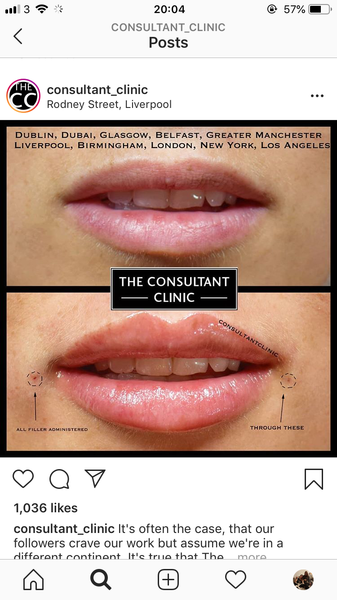 Lip Fillers