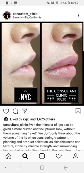 Lip filler, how much? Pic included