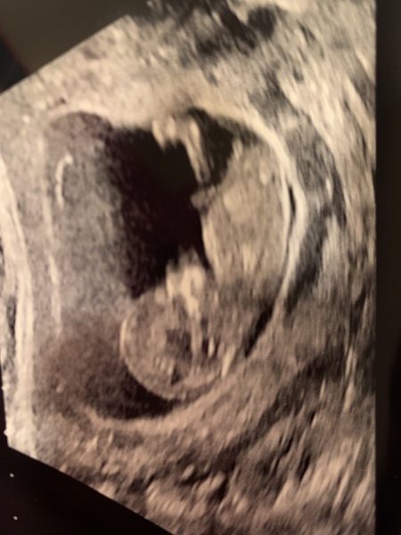 Sex guesses- 12 week scan