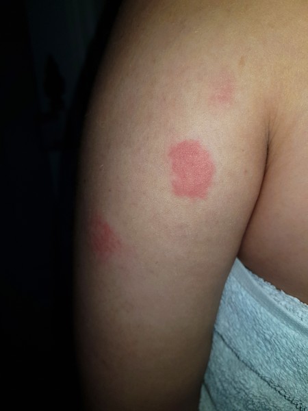 What could this rash be?