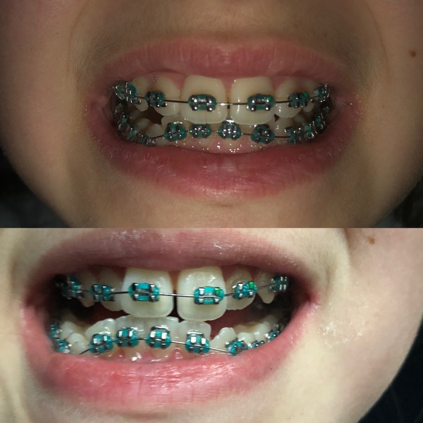 Twin Block Braces - Any Advice?