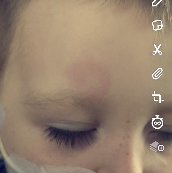 Rash