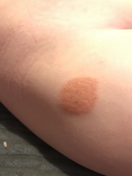 What is this on 2 year olds leg?