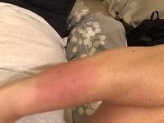 Cat bite infected?