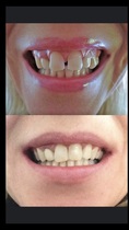 Braces/veneers