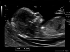 13 weeks nub theory