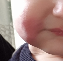 Rash / bruise like mark baby's mouth