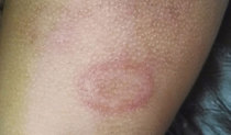 Eczema - any advice?