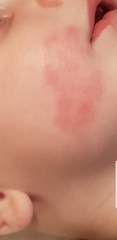 Rash / bruise like mark baby's mouth