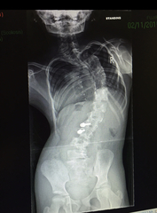 Self esteem and scoliosis