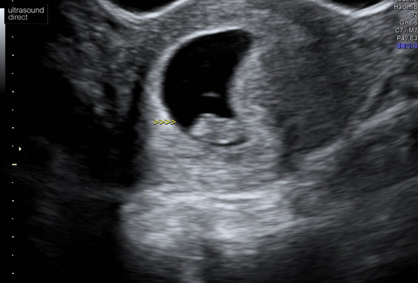 Scan photos at 7-8 weeks please