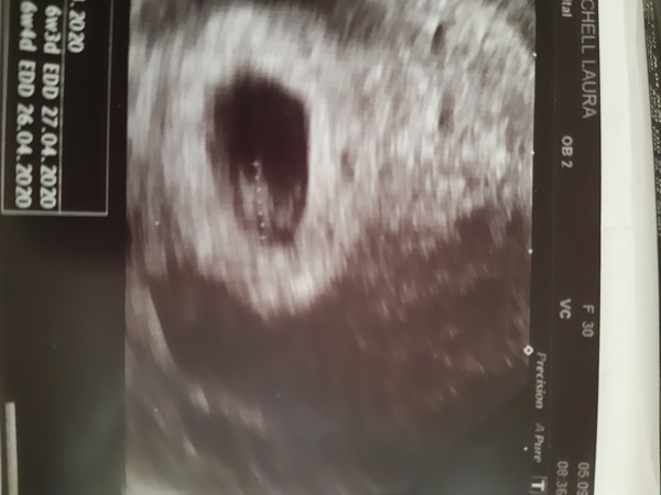 7 week scan, is this a normal shape,