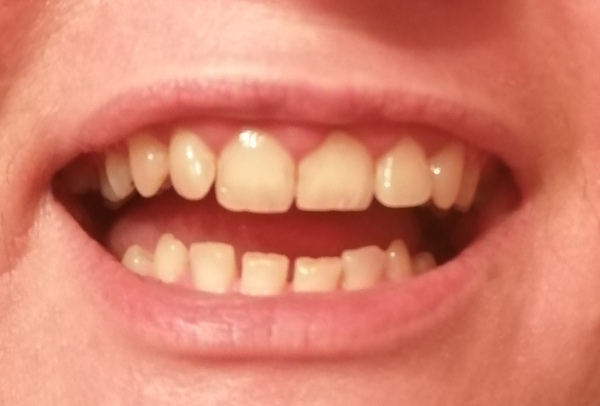 Remineralising teeth