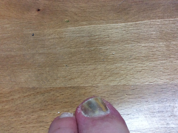 Anyone a podiatrist or know stuff about toes? *Warning gross toe picture*