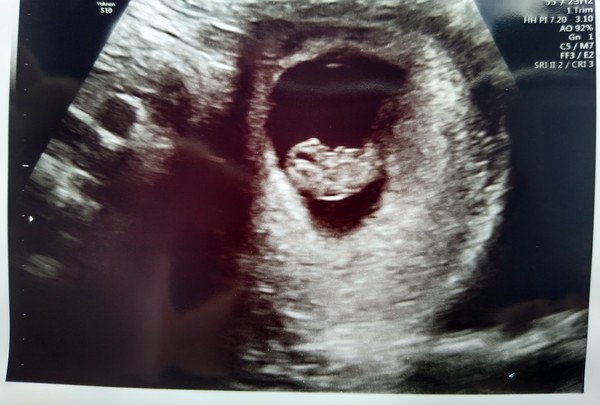 Scans at 8 weeks and 4 days