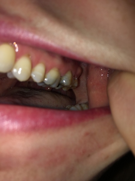Any dentists? What is this lump in my mouth?