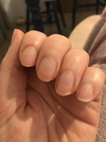 Anyone managed to stop biting their nails? How?