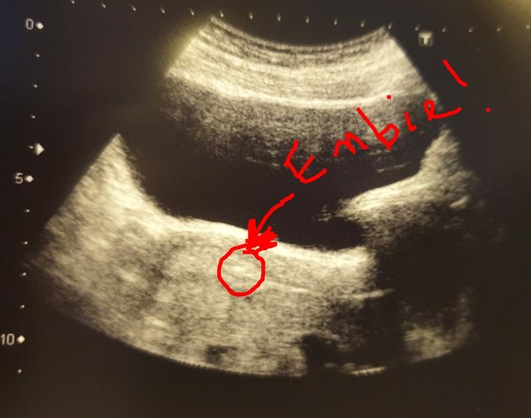 Dec/ Jan IVF support #2