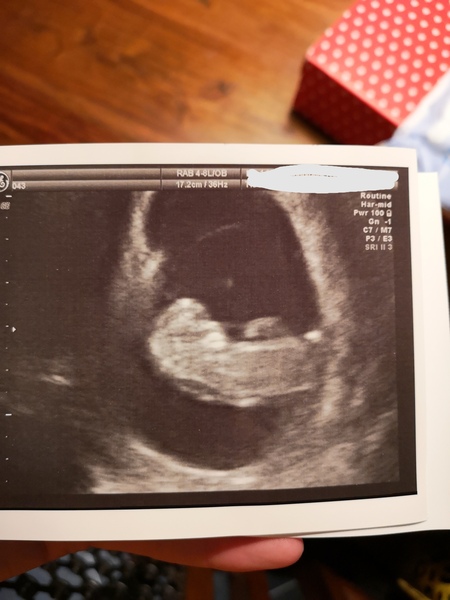 Help with anxiety, show me any 10 wk scans
