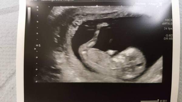 Boy or girl fun - 13 week scan