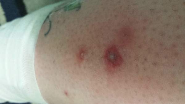 Infection from leg waxing.