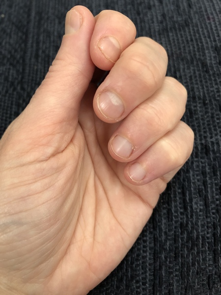 Anyone managed to stop biting their nails? How?