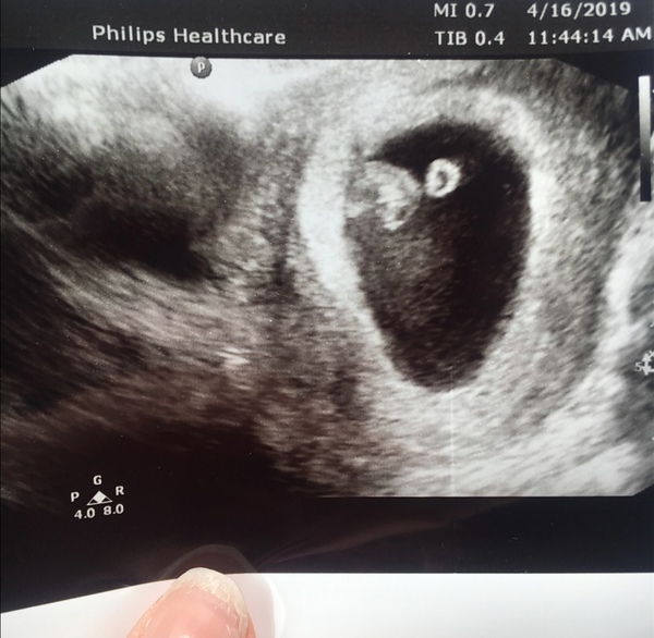 Does anyone have any 7 week scans they can share?