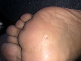 Has my verruca gone? (Photo)