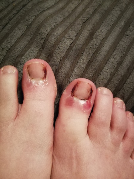 Nail surgery - warning foot picture included