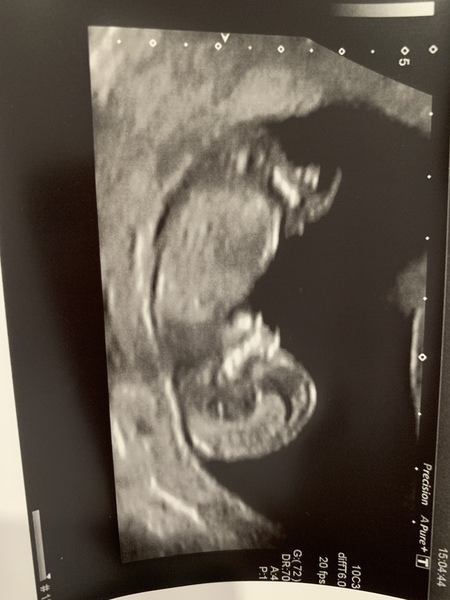 Help with anxiety, show me any 10 wk scans