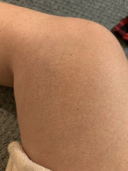 Itchy rash at 21 weeks