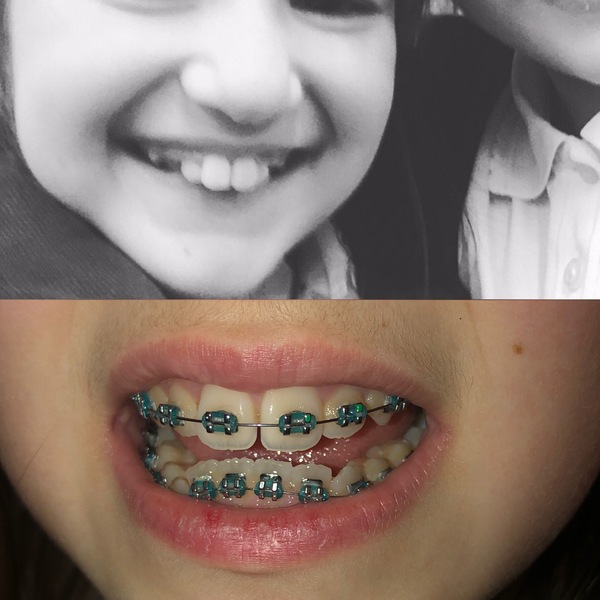 Twin Block Braces - Any Advice?