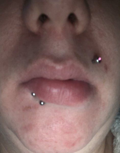 Can anybody recommend a concealer/ foundation to cover recent acne breakout/ scars