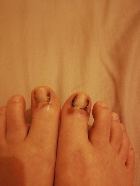 Nail surgery - warning foot picture included